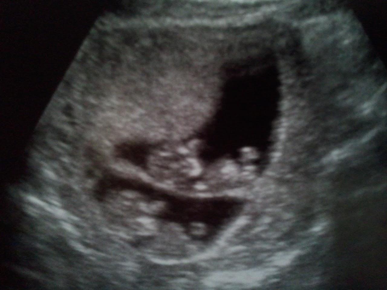 The twins at 10 weeks 5 days. The twins at 10 weeks 5 days.