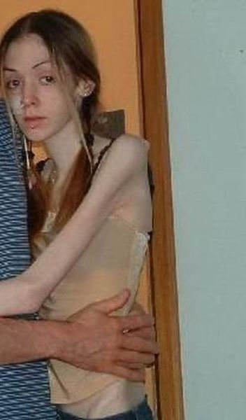 Pictures of anorexic girls naked - Excelent porn