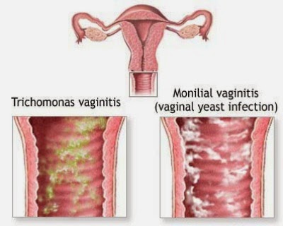 Homeocare International Pvt Ltd Vaginitis Causes Symptoms