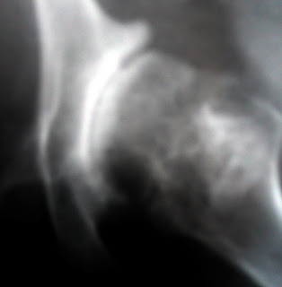 artrosis congruencia buena plastia artrosis de cadera perroi