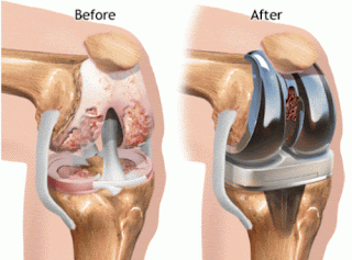 http://www.toshhospitals.com/knee-replacement.php