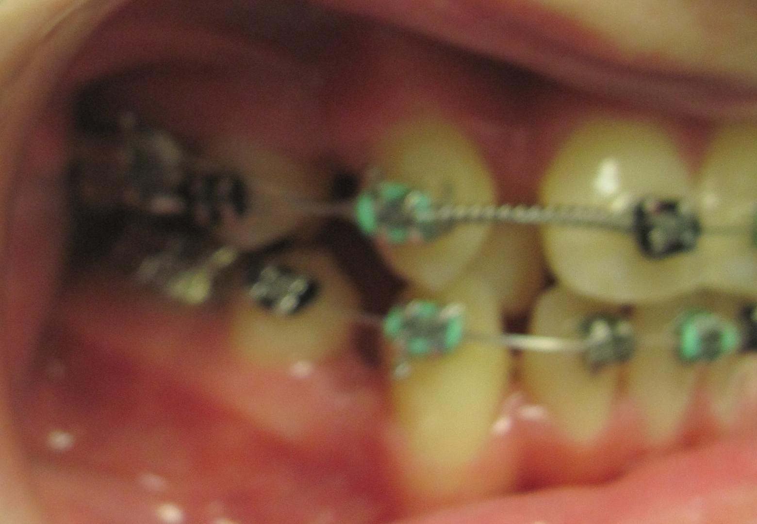 practical orthodontics Anterior labial root torque