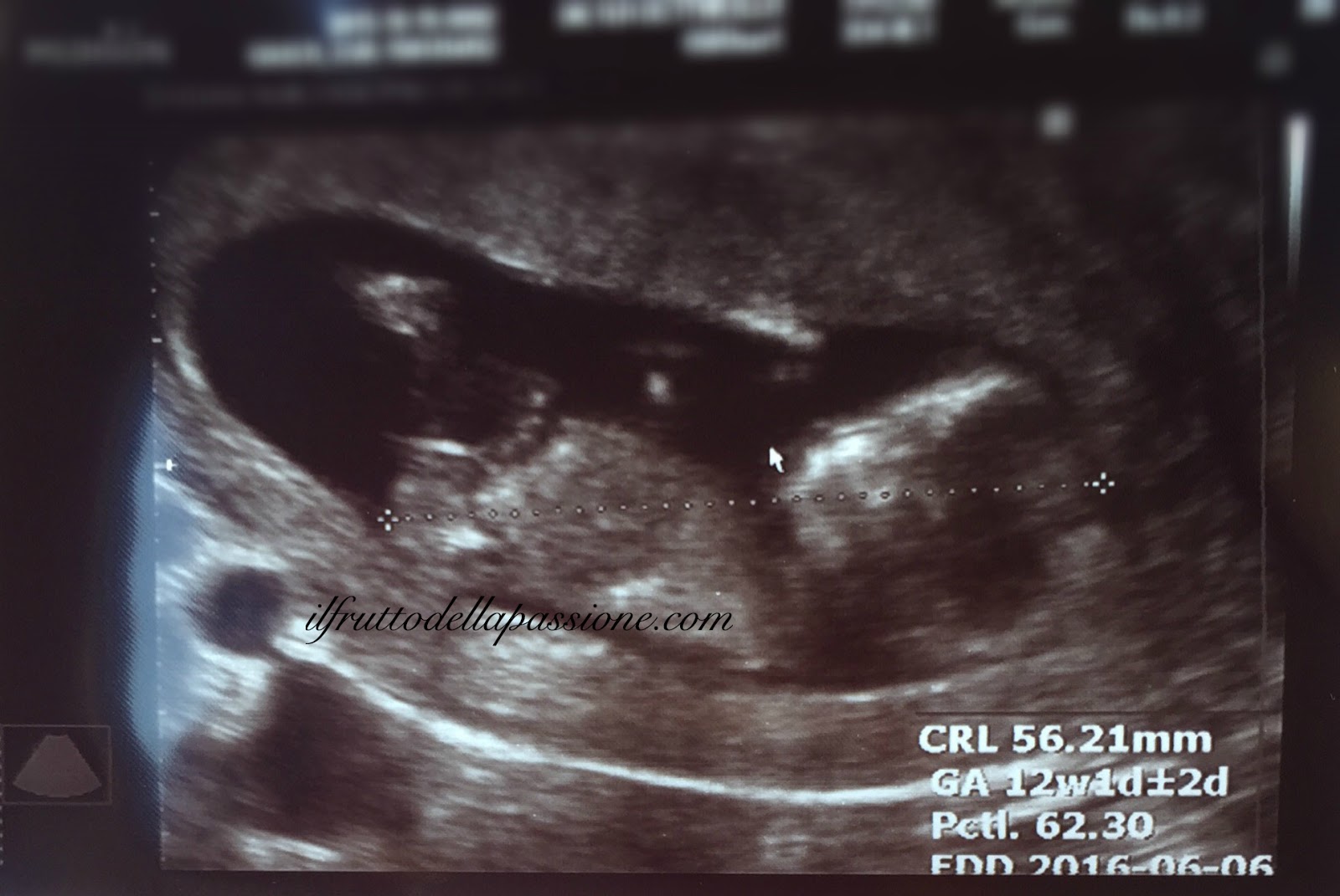 Dodicesima Settimana Morfologica Del Primo Trimestre E Translucenza Nucale Il Frutto Della Passione
