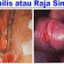 Obat Sipilis Paling Manjur Yang Aman thumbnail
