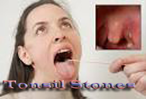 Adenoids Sinus Infections Adults : What Are Tonsils And How Do You Get Rid Of Stinky Throat Balls_