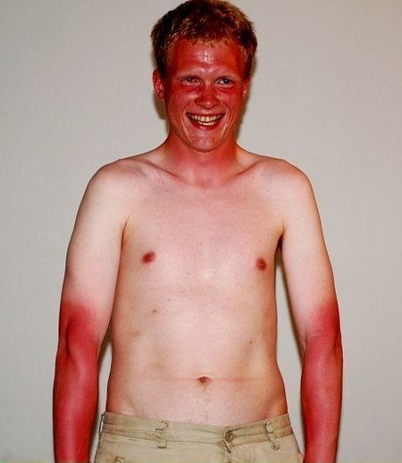 Sunburnt Ginger