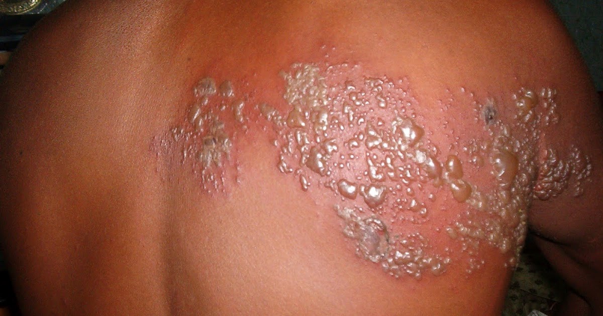 HEALTH FROM TRUSTED SOURCES: Herpes zoster