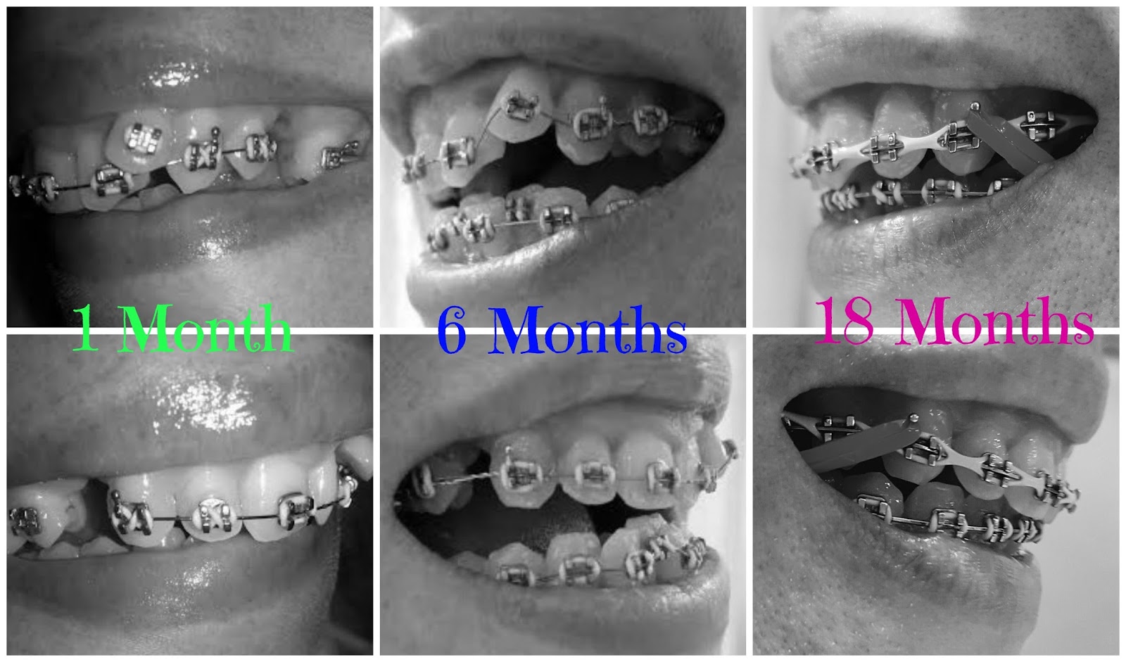 Adult Braces My Journey Year & a Half in Braces!!! Adjustment update!