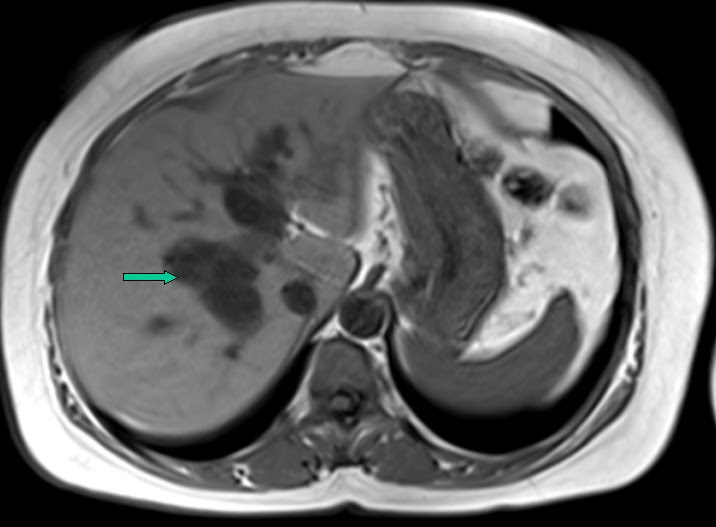 mricases Choledochal cyst Type IV MRI features