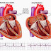 Fibrilhação Atrial ou Auricular – Definição, Causas, Sintomas, Diagnóstico, Tratamento, Prevenção