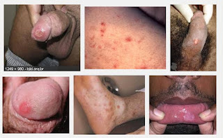 Obat Sifilis Ampuh Obat Sifilis Ampuh