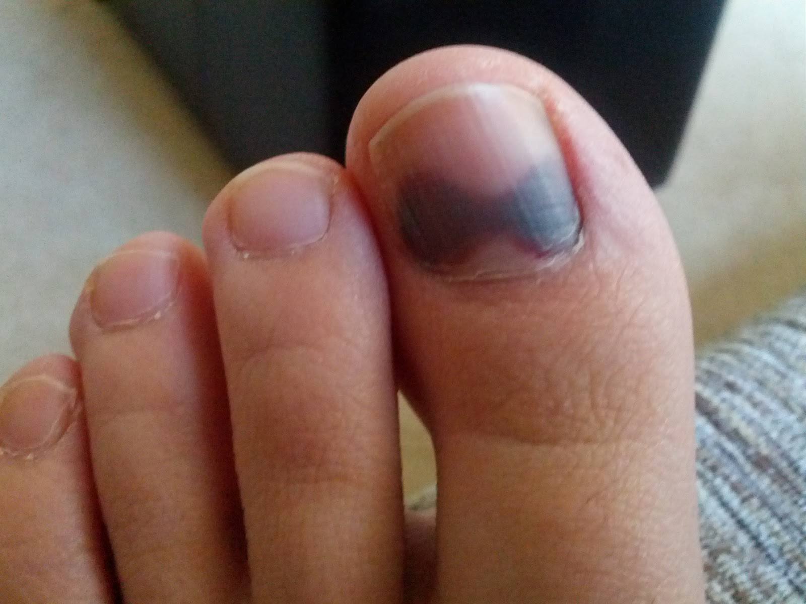 Je me suis dit que ça passerait. Mais ça passait pas. Une semaine après, je regarde mes orteils et HORREUR! Mes ongles de gros orteils sont noirs.