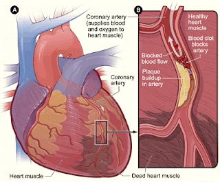 ICD 9 Code For Coronary Artery Disease