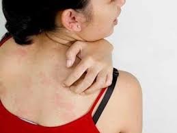 Penyakit Herpes Pada Tubuh Penyakit Herpes Pada Tubuh
