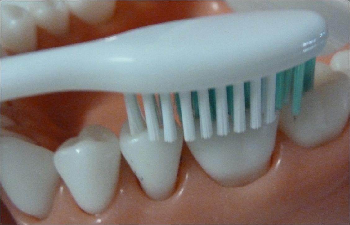 Dental Decay (Dental Cavity, Dental Caries)