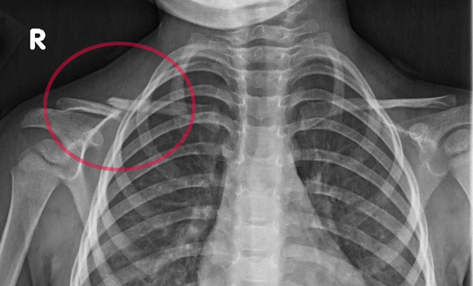 X Ray Pictures Of Broken Bones - 1600x970 - jpeg X Ray Pictures Of Broken Bones