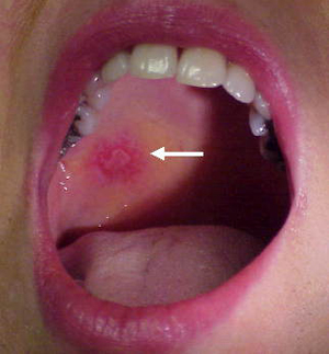 lupus mouth sores