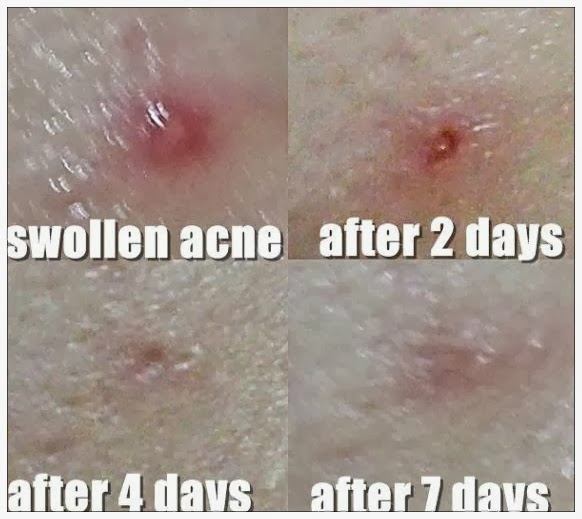 Sonia Verardo La Roche Posay Effaclar A.I. Review