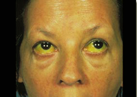 Jaundice.jpg