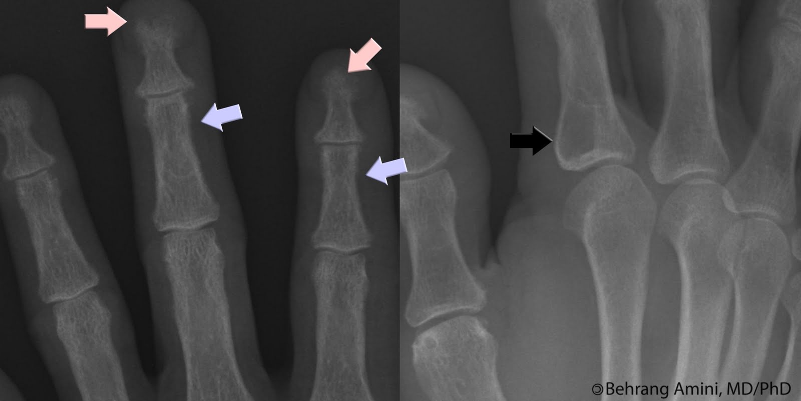 Roentgen Ray Reader Radiographic Features of Hyperparathyroidism