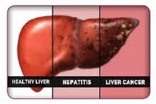 penyakit_liver
