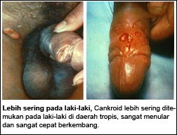 ciri ciri penyakit sipilis pada wanita, obat sipilis, pengobatan sipilis