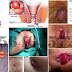 Mengobati Benjolan Wasir Meradang Gatal thumbnail