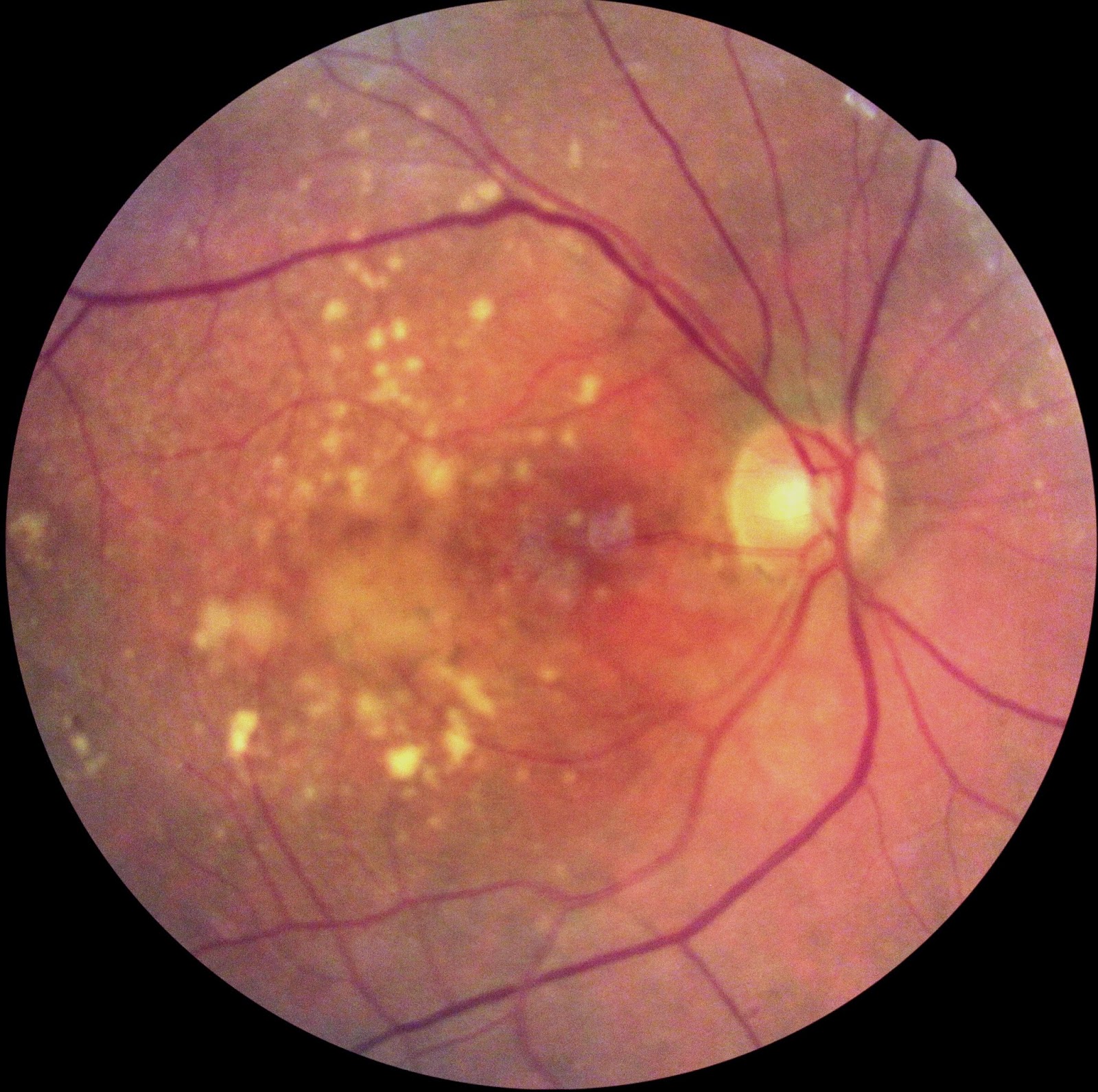 New Implantable Telescope Brings Better Vision to those with Advanced