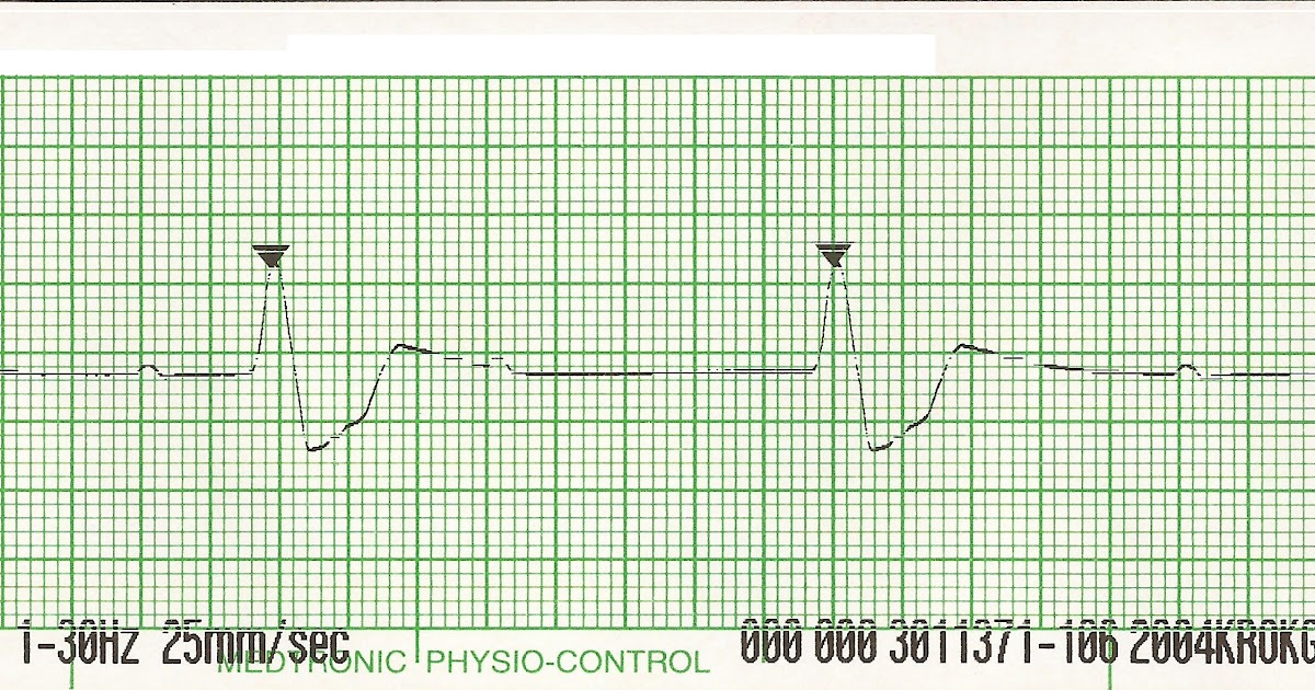 Float Nurse PALS Megacode Unstable Pediatric Bradycardia Part 3