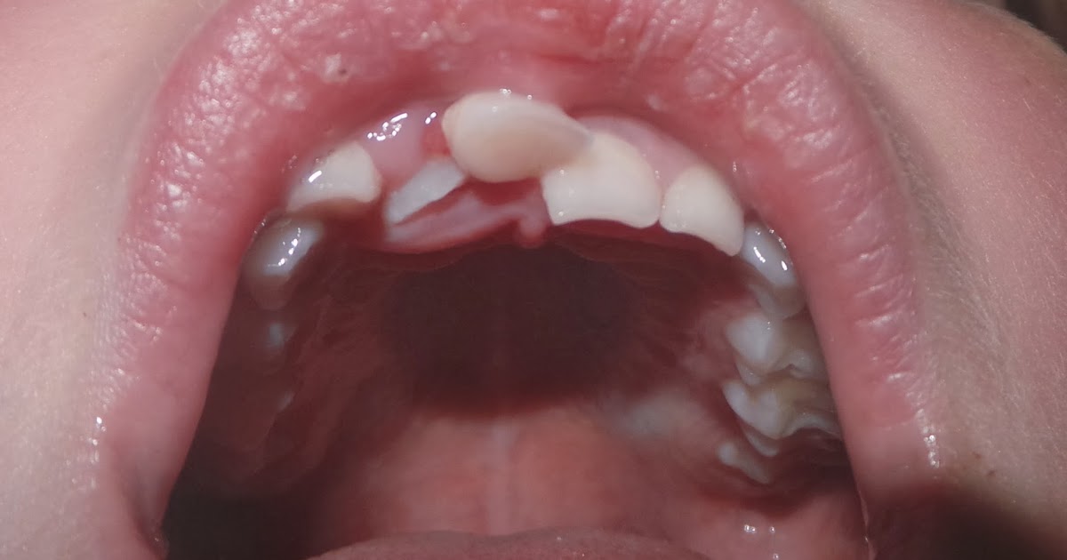 RELENTLESS How To Get Rid of an Unwanted Wobbly Tooth