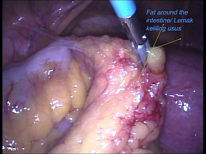 Fat Around The Intestine