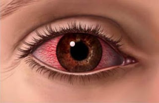 Menepis Mitos Bahaya Softlens Bagi Kesehatan