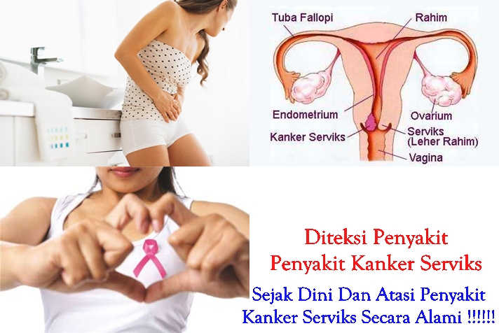 Obat Tradisional Kanker Serviks 