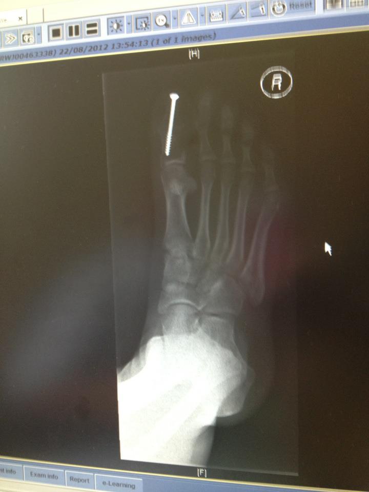 Rose Petals Toe fusion SUCCESS!