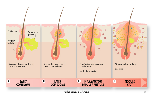How To Get Rid Of Inflammation On Face How To Get Rid Of Inflammation On Face