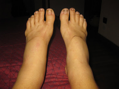 Freak Feet - Swelling after 100 hours of running