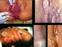 Cara Mengobati Kutil Dipenis Cara Mengobati Kutil Dipenis