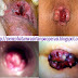 Obat Wasir Alternatif thumbnail