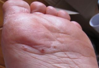 Dyshidrose La dyshidrose est une forme d' eczéma, dit eczéma bulleux, surtout présent sur les faces palmaires et/ou plantaires. Le nom provient du mot dyshidrotique, signifiant mauvaise sueur laquelle fut autrefois perçue comme la cause. Quelquefois elle est appelée Pompholyx (bulles en grec), terme généralement réservé pour les cas de vésicules pruritiques profondes.