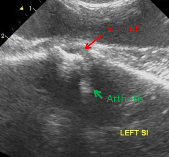Michael Porter, Equine Veterinarian Sacro Iliac Injection!