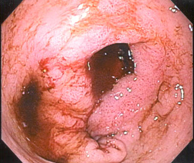 Gastric Ulcer Pictures