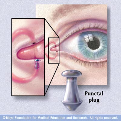 Everything You Need To Know About Punctal Plugs Eyedolatry Not Everyone Is A Candidate For Punctal Plugs If You Have Blepharitis Meibomian Gland Dysfunction Ocular Rosacea Symptoms That Are Greatly Flared Up