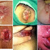 PENYAKIT WASIR PADA WANITA thumbnail