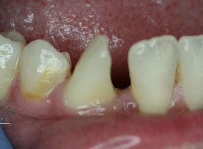 rotated tooth