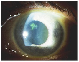 Photos For Herpes Simplex Keratitis (HSK) - Dendritic Corneal Ulcer ~ YOUNG DOCTORS' RESEARCH FORUM