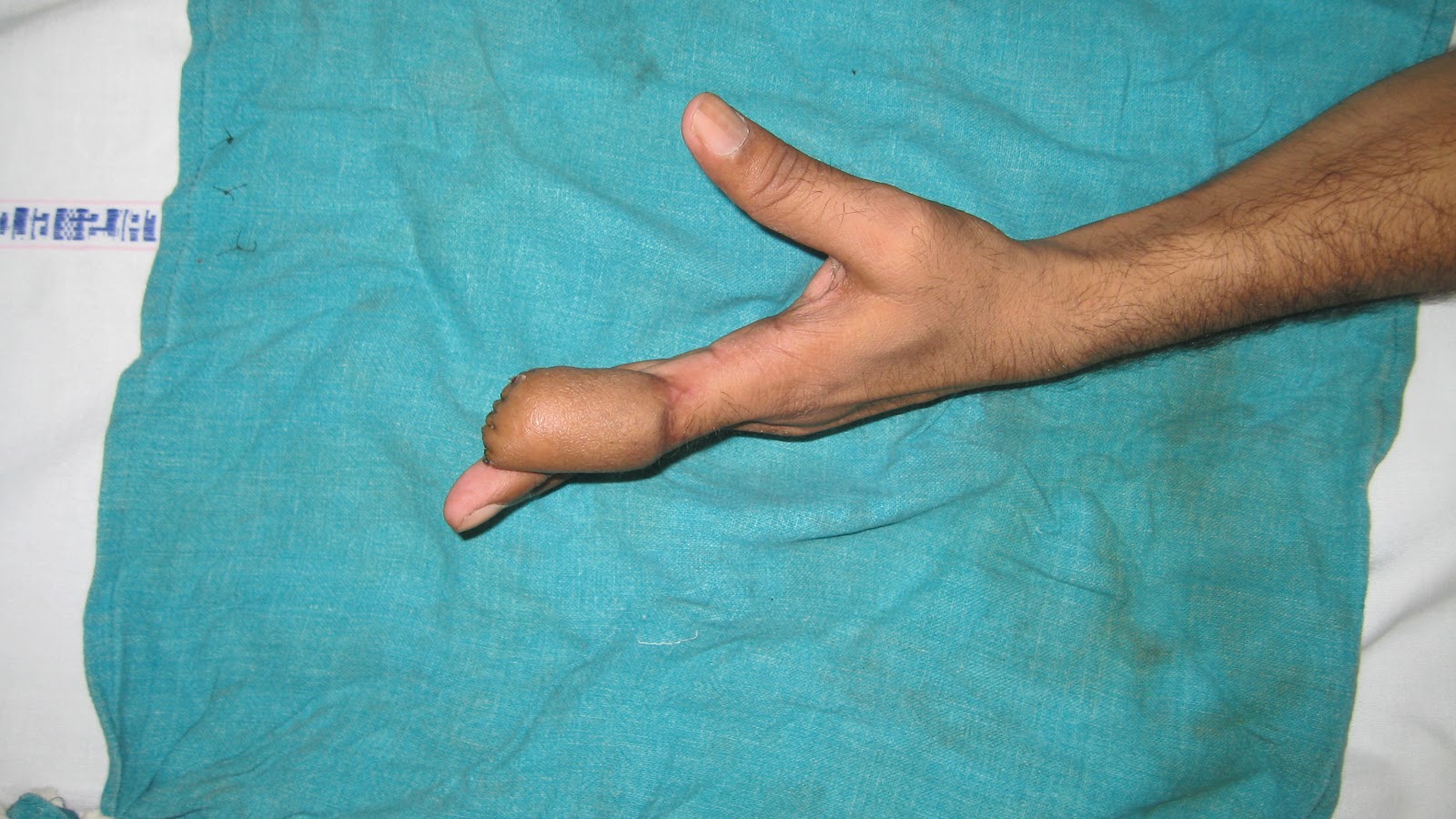 Groin Flap