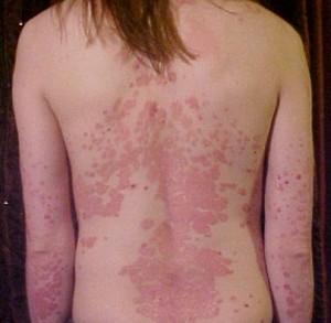 Cara Terbaik Menyembuhkan Psoriasis Dengan Cepat Cara Terbaik Menyembuhkan Psoriasis Dengan Cepat