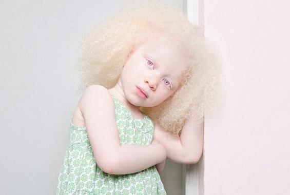 New York Photographer Captures Albino Beauty In An Amazing Photoshoot