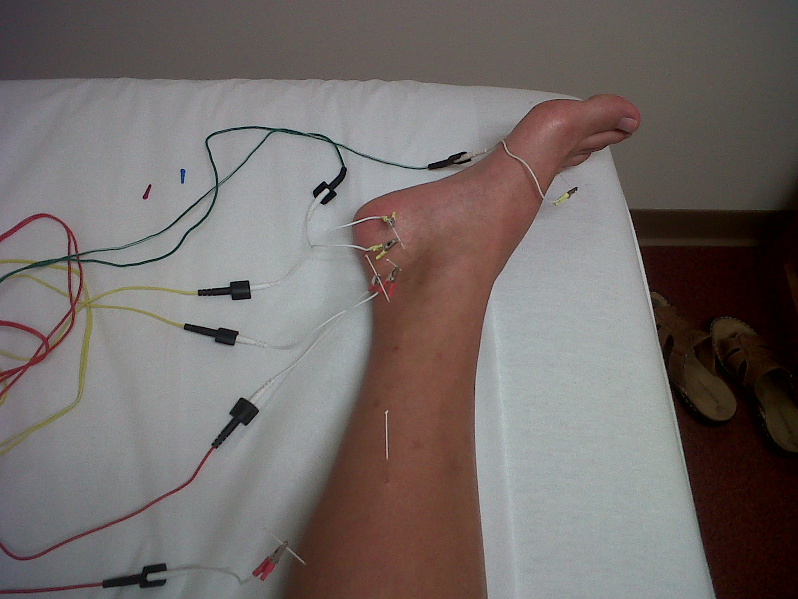 Acupuncture How Fast Does It Work at Louise Blackwell blog