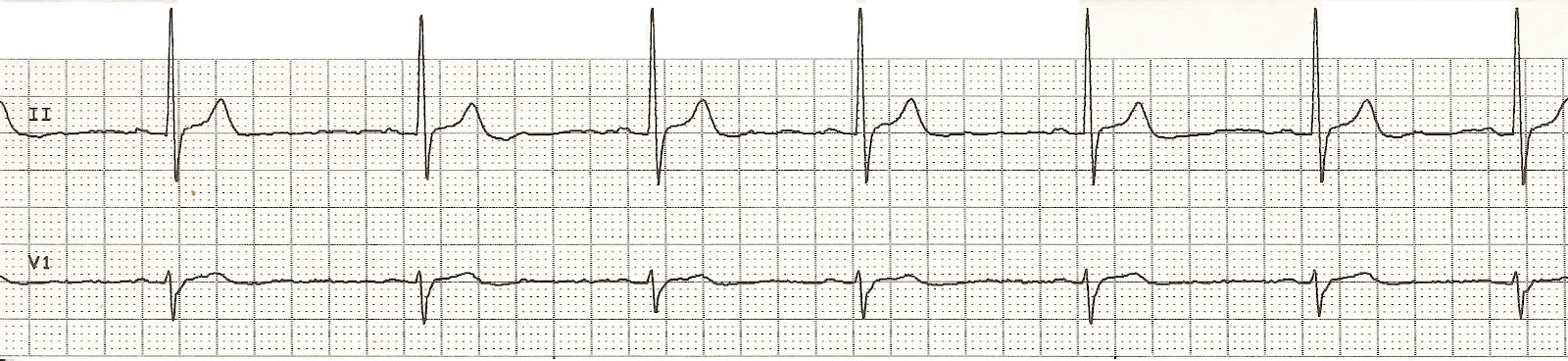 Bradycardia